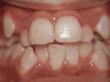https://www.theurerorthodontics.com/wp-content/uploads/2024/01/crowding-of-the-teeth-before-1.jpg