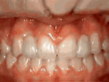 https://www.theurerorthodontics.com/wp-content/uploads/2024/01/missing-lateral-incisors-after-1.jpg