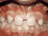 https://www.theurerorthodontics.com/wp-content/uploads/2024/01/missing-lateral-incisors-before-1.jpg