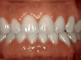 https://www.theurerorthodontics.com/wp-content/uploads/2024/01/spacing-of-teeth-after.jpg