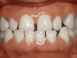 https://www.theurerorthodontics.com/wp-content/uploads/2024/01/spacing-of-teeth-before.jpg